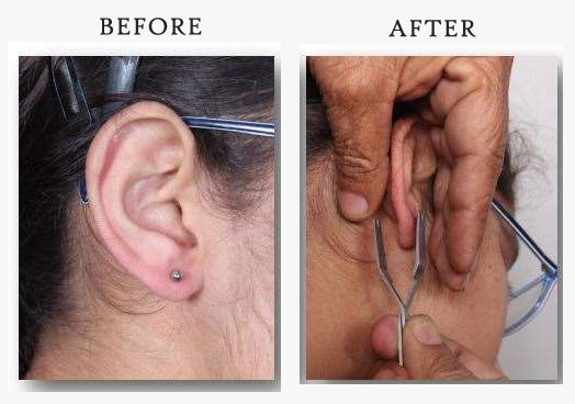 Safe ear piercing kit response